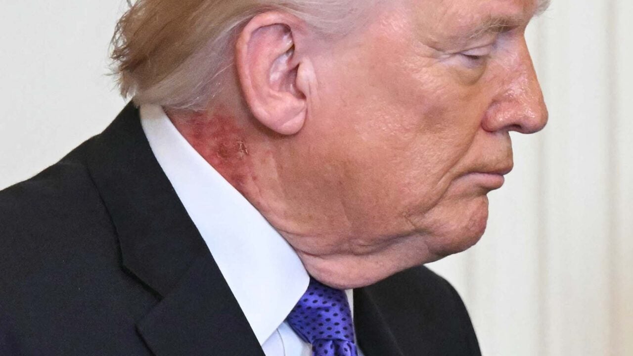 Trump’s Neck Features Spark Speculation Regarding Potential Health Issues